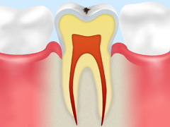 初期の虫歯（CO）