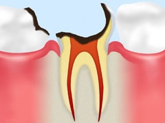 歯の根の虫歯（C4）